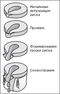 Остеохондроз. Как победить боль