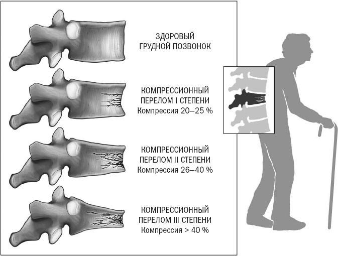 Йога при остеопорозе