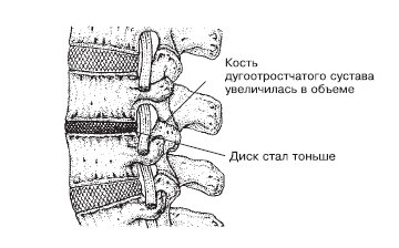 Боль в спине. Как определить причину и устранить приступ