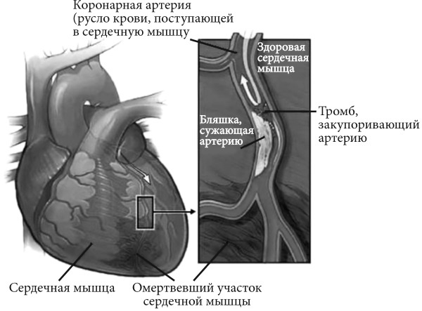 Лучшие методы лечения и профилактики инфаркта миокарда