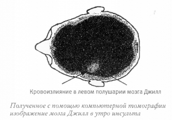 Мой инсульт был мне наукой. История собственной болезни, рассказанная нейробиологом